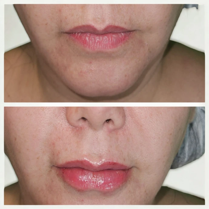 relleno acido hialurónico