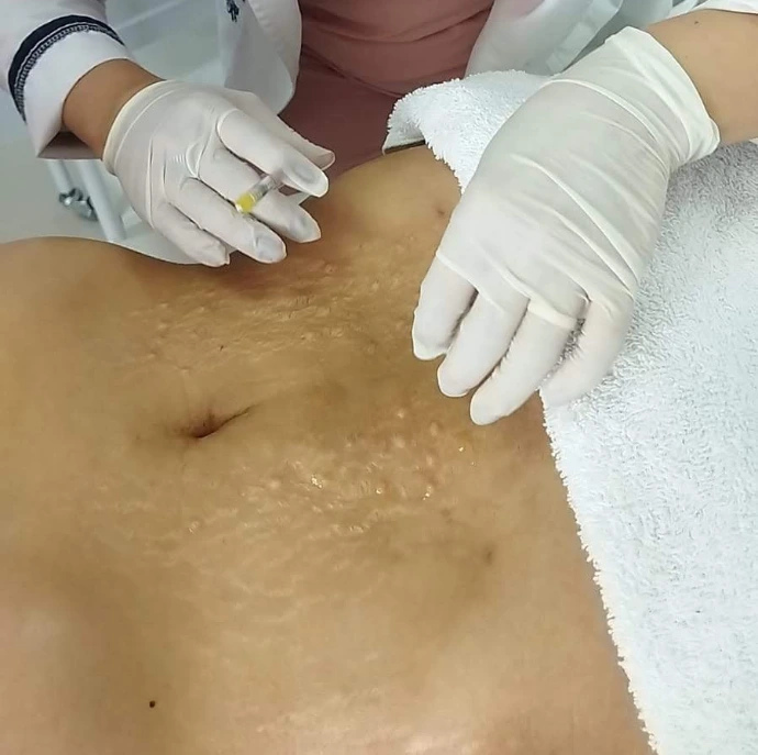 tratamiento estrías